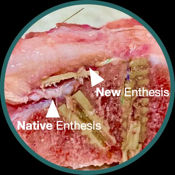 WingHeal bioinductive bone repair